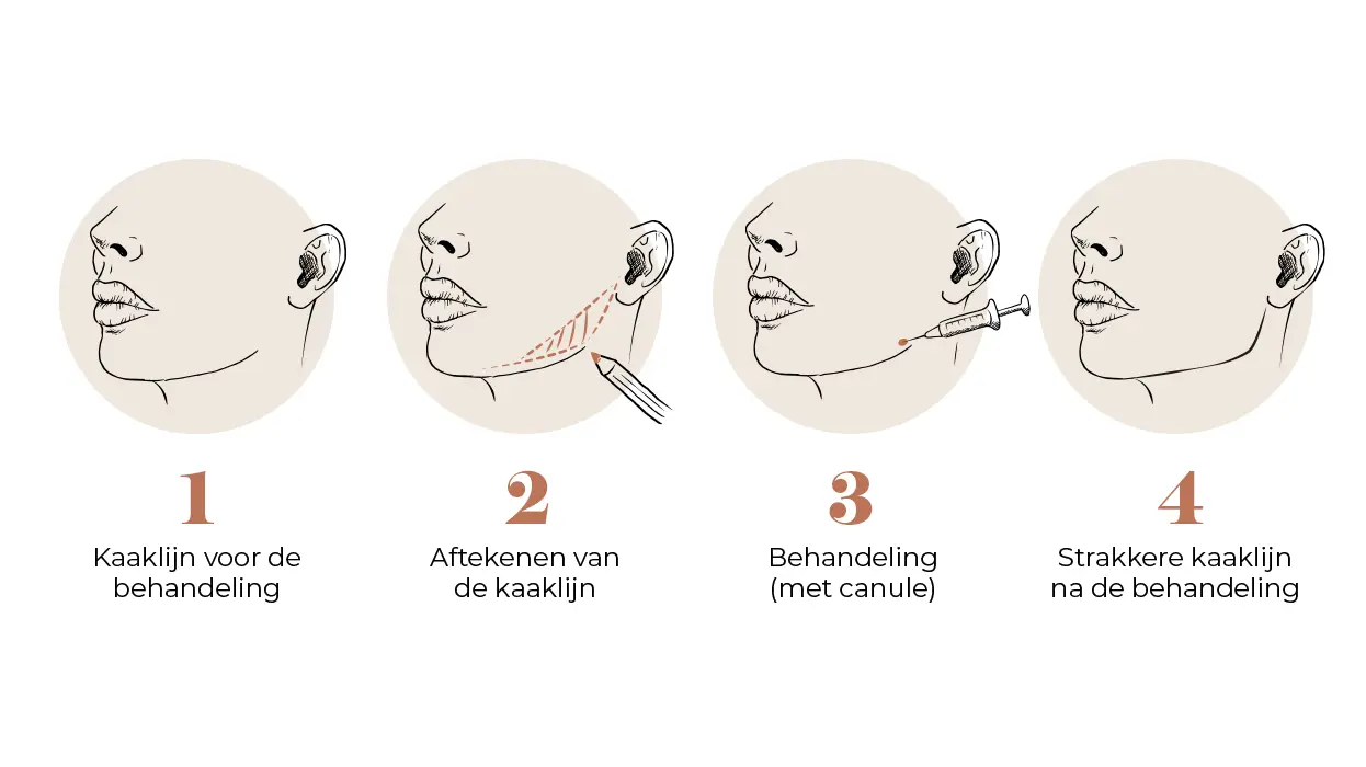 Ablauf Jawline Filler