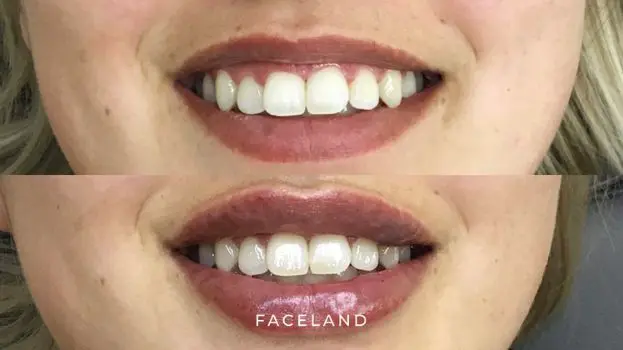 Lip filler behandeling