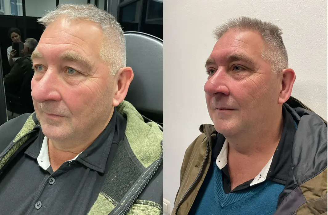 Geen spijt van ooglidcorrectie: Roel (64) over zijn operatie